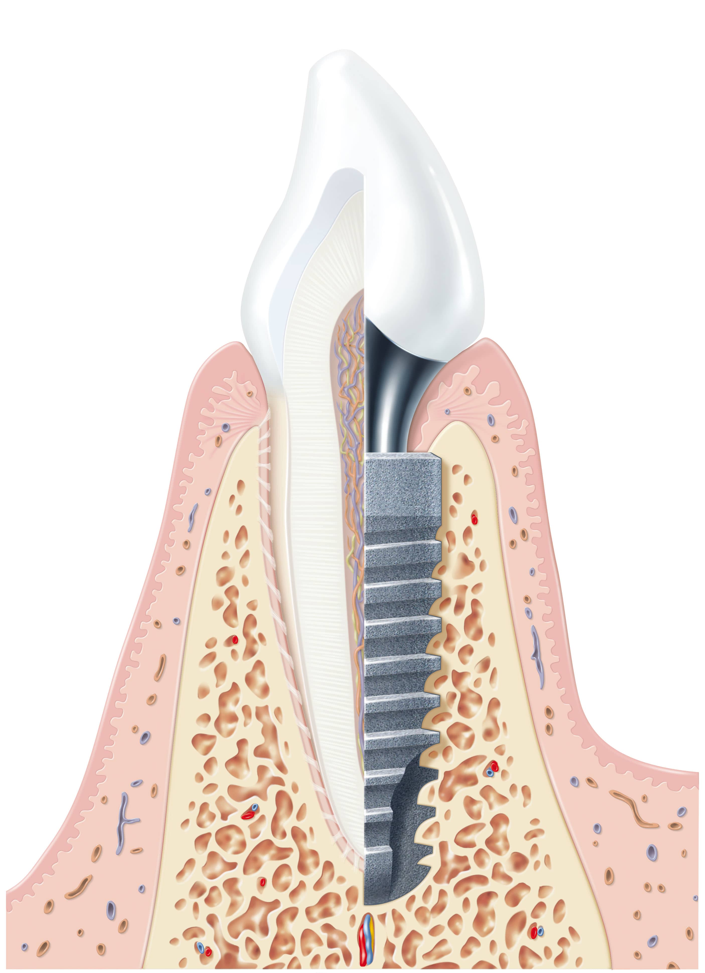 Implanty Dentsply Sirona