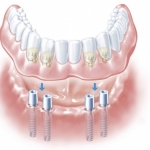 implant friadent warszawa