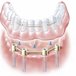 implant friadent warszawa centrum