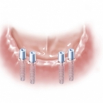 implant friadent warszawa