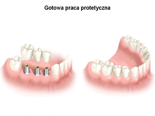 implant warszawa