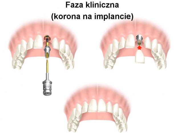 implant warszawa