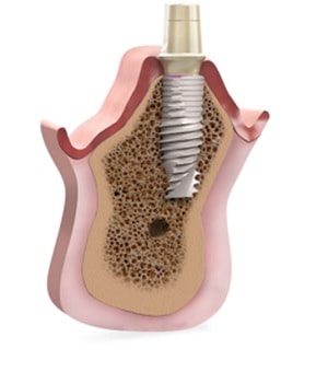 implant v3 warszawa