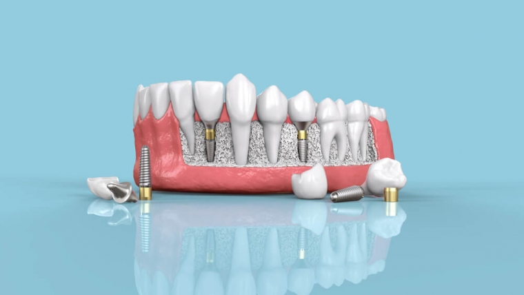 Czy pacjenci z zanikiem kości mogą zdecydować się na implanty zębowe?