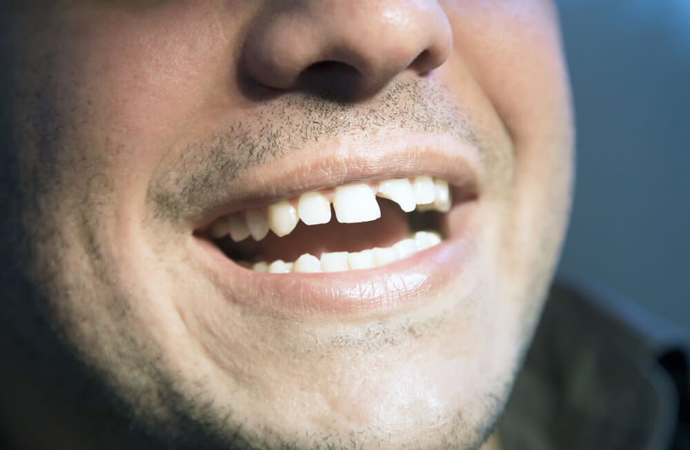 Złamany ząb — co dalej?