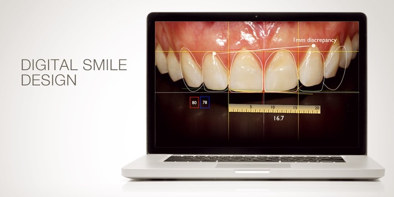 Digital Smile Design, czyli projektowanie zdrowego i pięknego uśmiechu