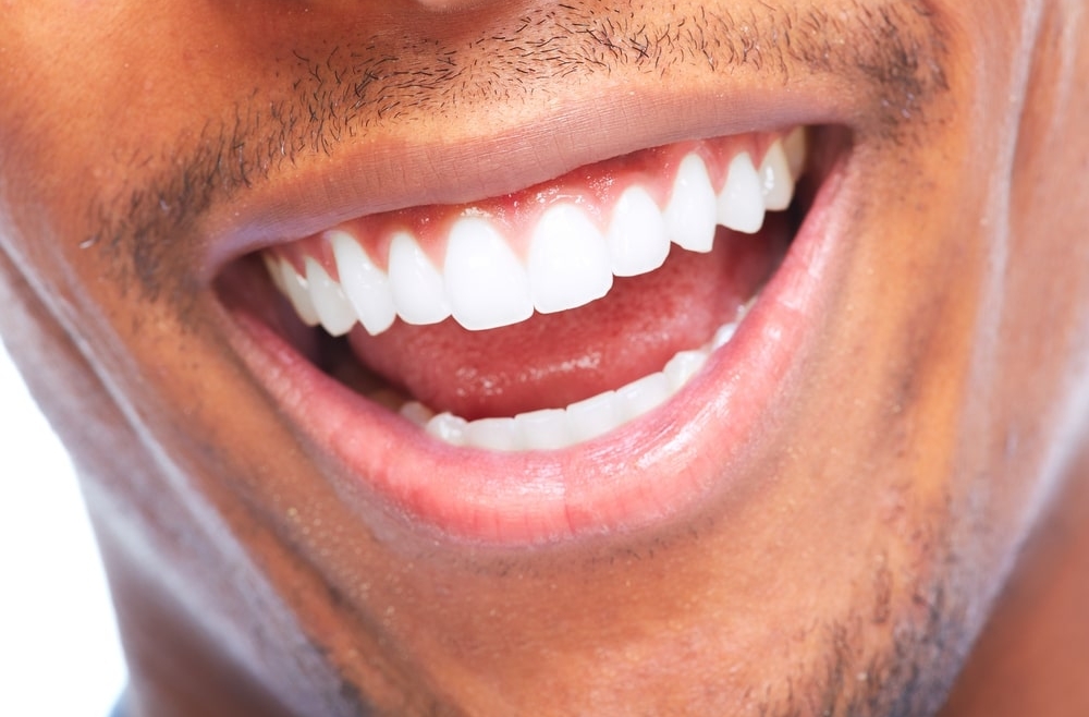 Wybielanie zębów – która metoda będzie najlepsza?