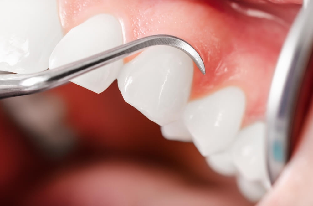 Leczenie periodontologiczne – dlaczego warto pamiętać o przeglądach?