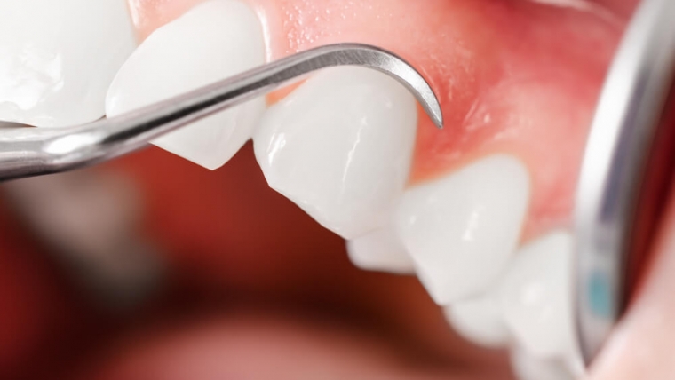 Leczenie periodontologiczne – dlaczego warto pamiętać o przeglądach?