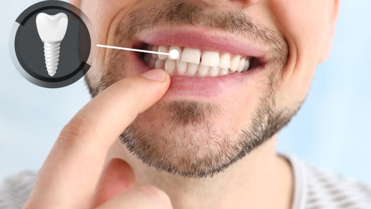 Sprawdź, jak skutecznie dbać o implanty stomatologiczne, by posłużyły jak najdłużej