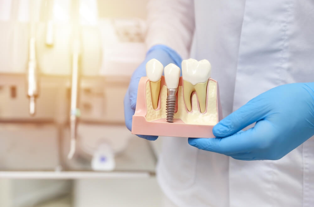 Czy choroby przyzębia są przeszkodą do wszczepienia implantów zębowych?