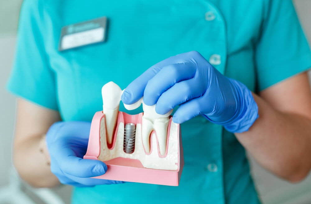 Implantologia — czy można wstawić implanty w miejsce dawno utraconych zębów?