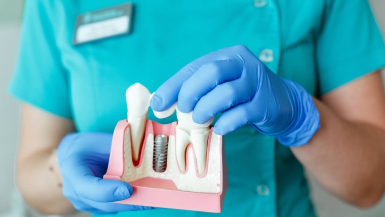 Implantologia — czy można wstawić implanty w miejsce dawno utraconych zębów?