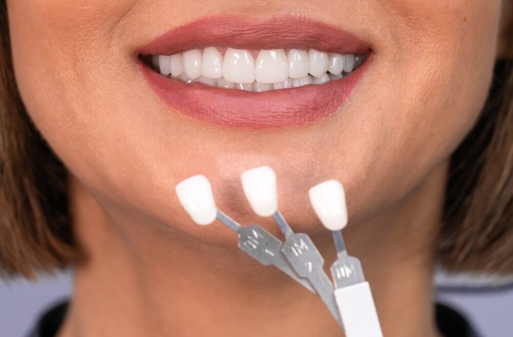 Licówki zębowe – czy zawsze można je zastosować?