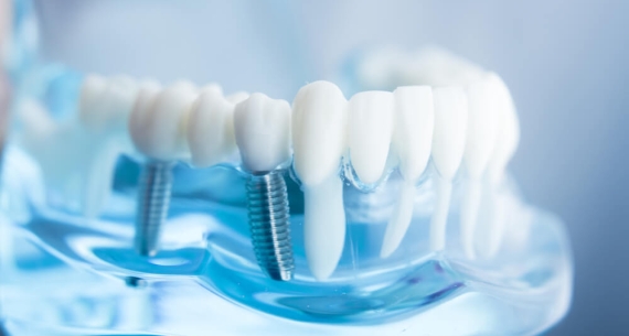 Implanty stomatologiczne zębów – dlaczego wybór systemu ma znaczenie?