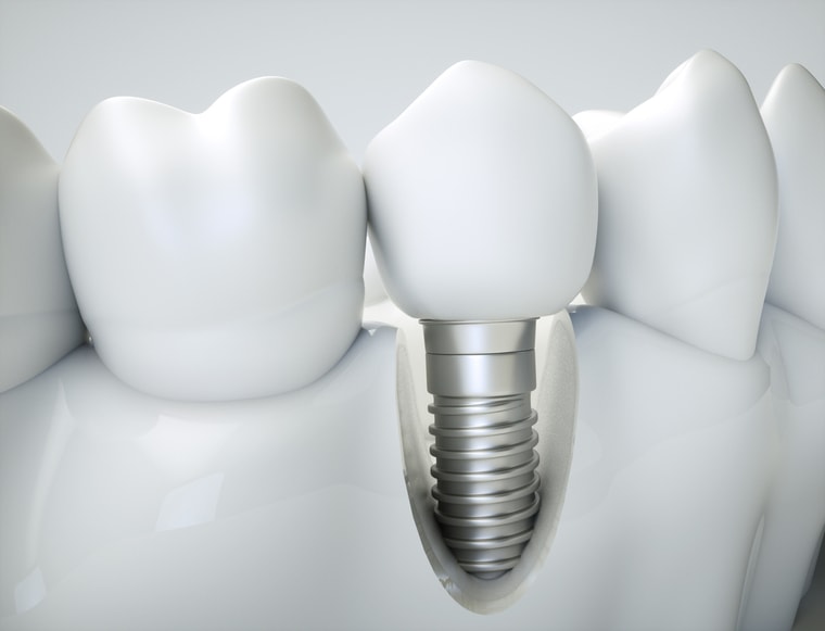 Model implantu zębowego wszczepionego w kość między naturalnymi zębami