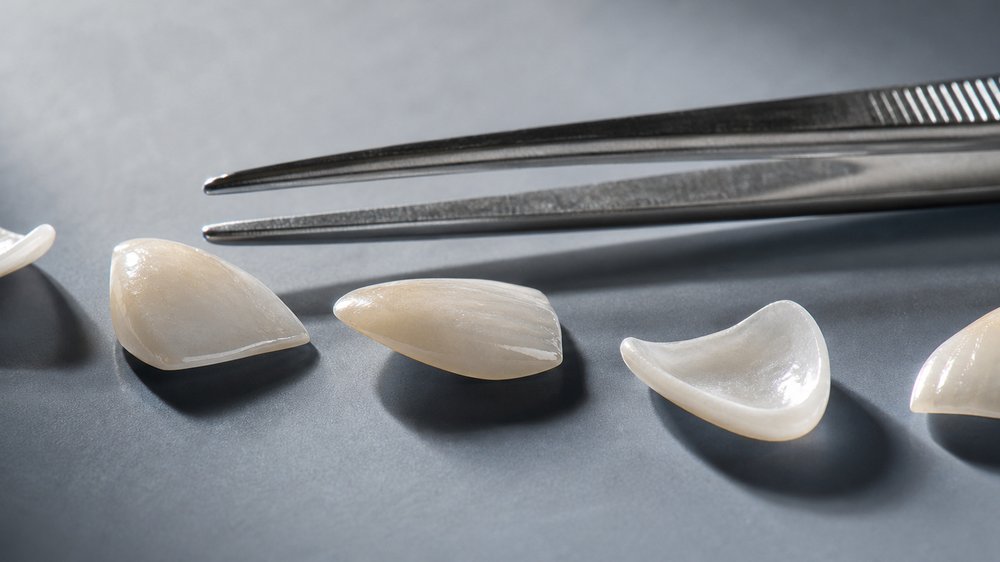 Licówki porcelanowe i pinceta dentystyczna — cienkie łupinki ceramiczne w zbliżeniu